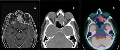 Olfactory neuroblastoma: diagnosis, management, and current treatment options